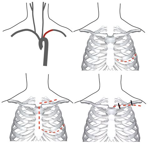 Thoracic Vascular Trauma The Operative Review Of Surgery
