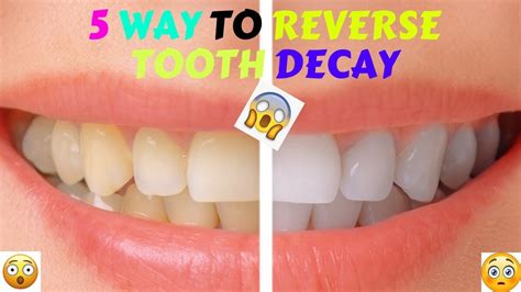 We already know that consuming products with high sugar content leads to tooth decay and that phytic acid can block calcium absorption. 5 Simple And Natural Ways To Reverse Cavities And Heal ...