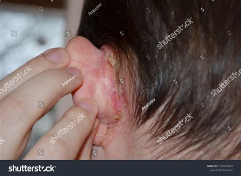 Psoriasis Behind Ear Psoriasis On Nails Stock Photo 1148766869