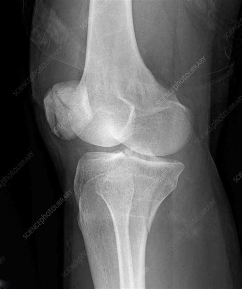 Broken Knee Cap X Ray Stock Image F0360220 Science Photo Library