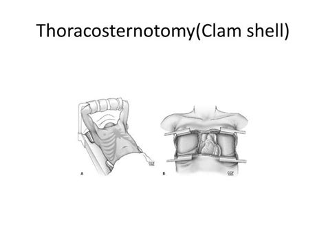 Ppt Thoracic Incisions Powerpoint Presentation Id391276