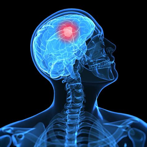 Brain Tumors Overview And More