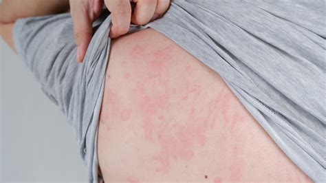 Unexpected Complications Of Severe Eczema Health Digest Trendradars