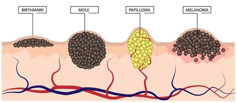 How To Detect Cancerous Moles How To Tell If A Mole Is Cancerous