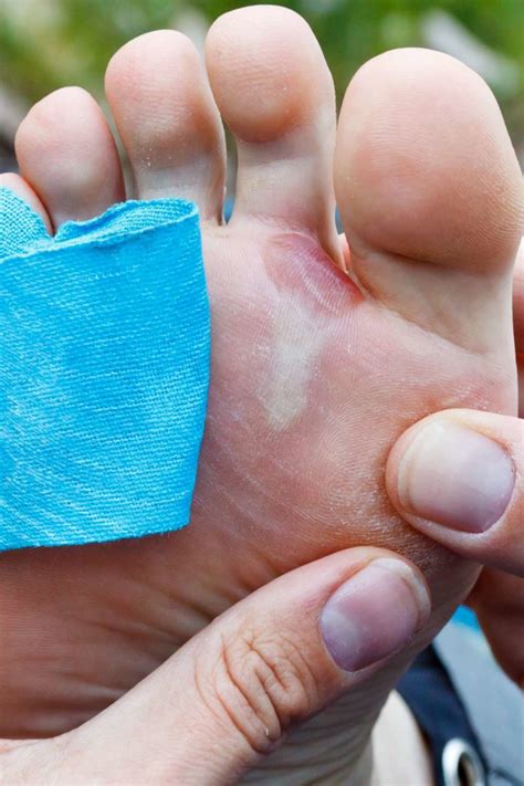 Should You Pop A Blister When To Do It Safe Methods And Tips