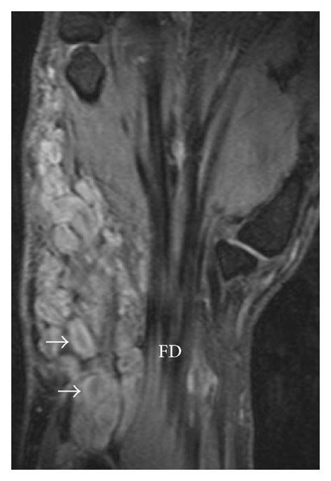 Axial T2 Weighted Wrist Mri With Fat Suppression—multilobulated Right