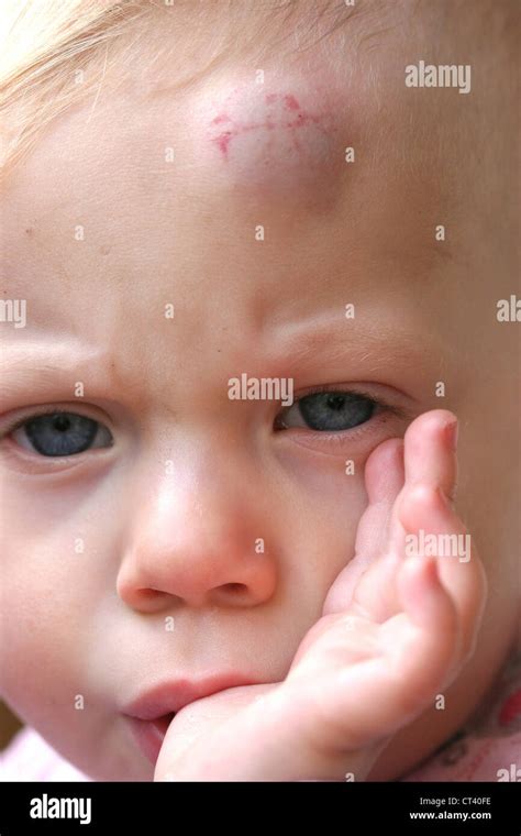 Child With Hematoma Stock Photo Alamy