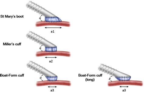 A Novel Method Of Vein Cuff Creation For Below Knee Femoropopliteal