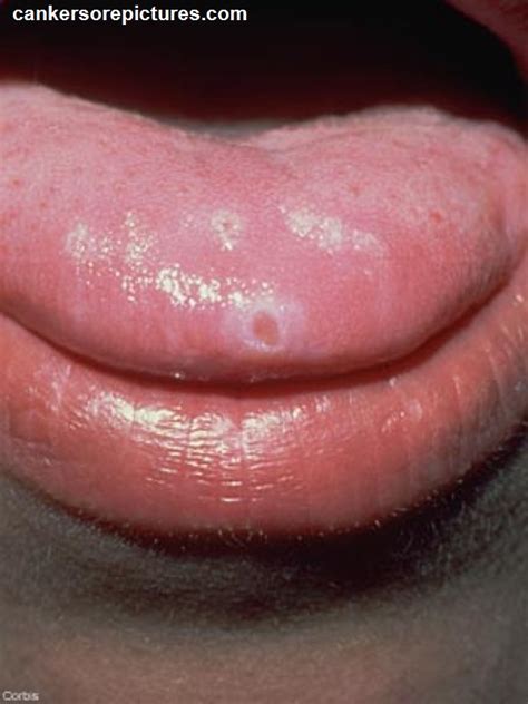 Canker Sore In Mouth Tongue Lips And Gums Pictures