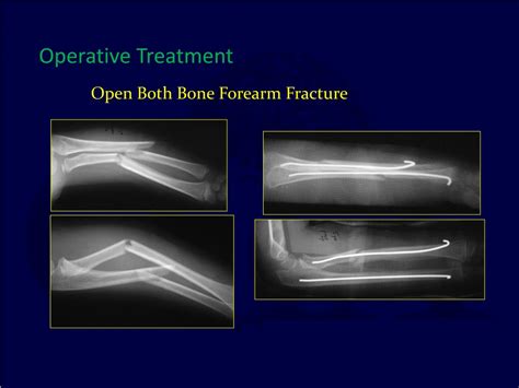 Ppt Pediatric Fractures Of The Forearm Wrist And Hand Powerpoint