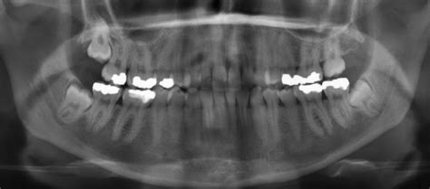 Panoramic Radiograph Showing Bilateral Impacted Mandibular Third Molars