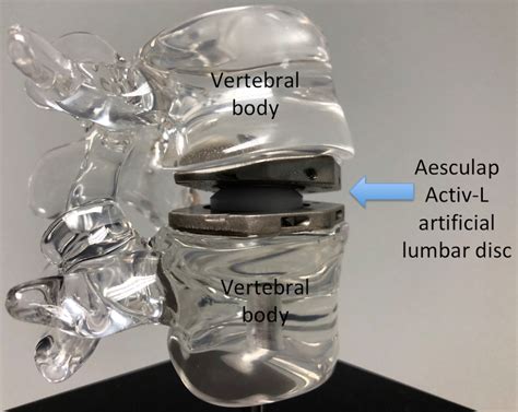 Artificial Disc Replacement Adr Rocky Mountain Brain And Spine