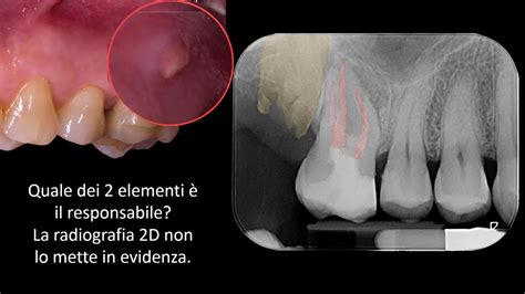 Dente Devitalizzato Che Fa Male Youtube