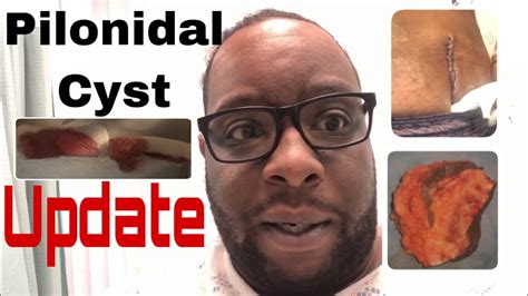 My Pilonidal 💉🔪 Cyst 💊surgery Update 2 Youtube
