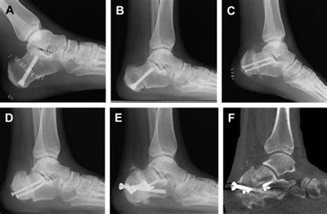Calcaneal Osteotomies Foot And Ankle Clinics