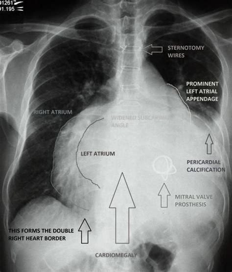 Mitral Heart Radiology Case Radiology Radiology
