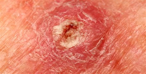 What Does Squamous Cell Carcinoma Look Like