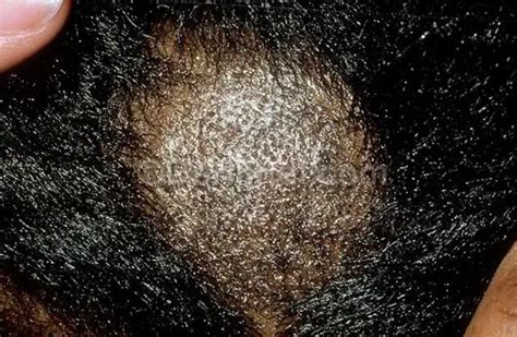 Scabs On Scalp Causes Treatment And Remedies Treat Cure Fast