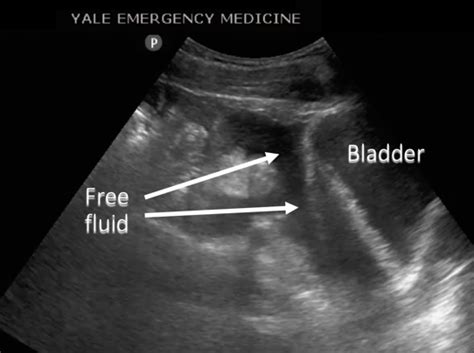 You can adjust your cookie preferences at the bottom of this page. Pelvic Free Fluid | Lesson #106