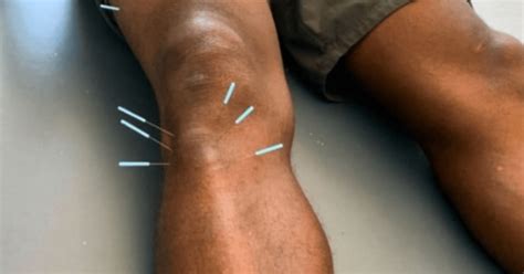 9 frequently asked questions about dry needling back in motion physical therapy and performance