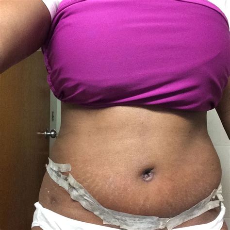 3 Weeks From Having My Tummy Tuck Navel Healing Well Stomach Is Swollen Still Back To Work