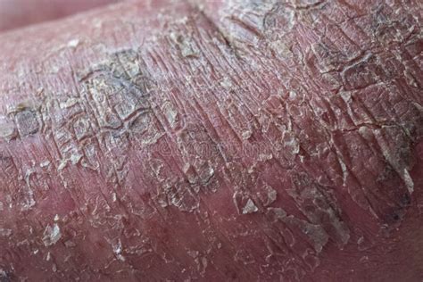 Closeup Of Cracked And Dry Skin Disease Medical Healthcare Concept
