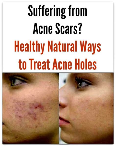 Pin On Caring For Acne