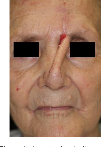 Figure 2 From Paramedian Forehead Flap For Nasal Tip Reconstruction