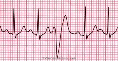 Pvc Ekg Types