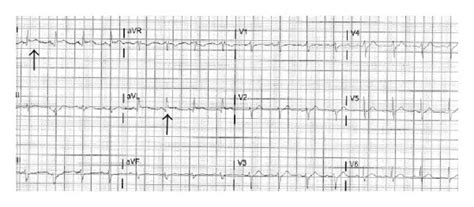 A Ekg During Chest Pain St Elevation In Leads I And Avl B Normal