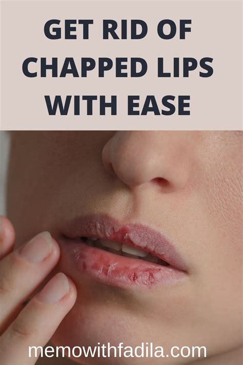 Get Rid Of Chapped Lips With Ease Memo With Fadila