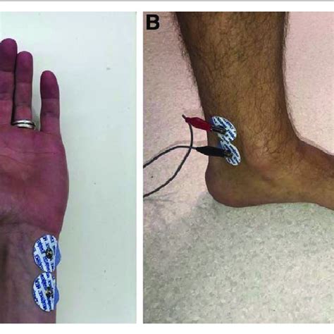 Peripheral Nerve Stimulation Technique For Ulnar A And Posterior