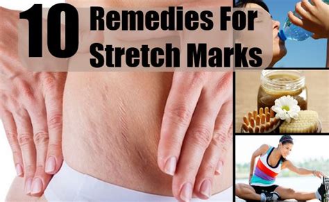 Top 10 Home Remedies For Stretch Marks Natural Treatments And Cure For