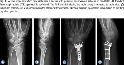 Radiographic Images Of 64 Aged Female With Distal Radius Fracture And