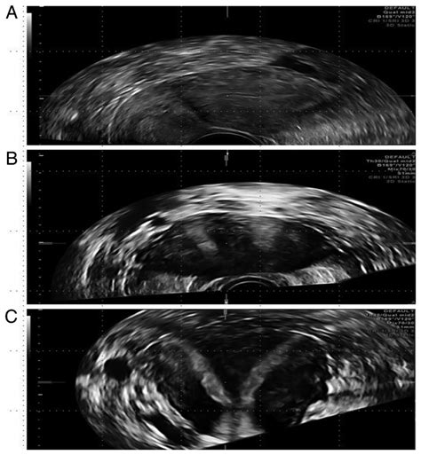 Septate Uterus A 2d Ultrasound Longitudinal Plane Of The Uterus B