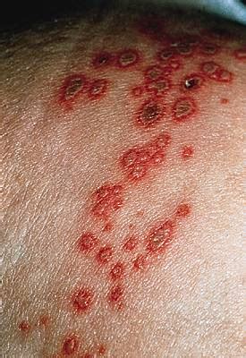 COMMENT SOIGNE-T-ON UN ZONA? | Nuage Ciel d'Azur