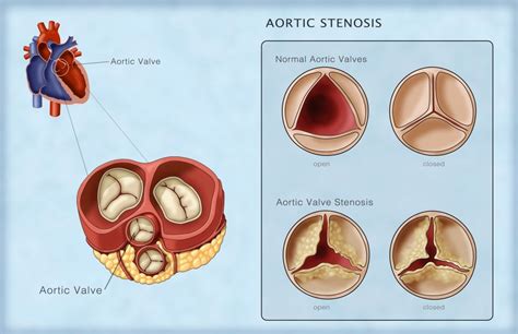 Aortic Valves Normal And Stenosis Illustration Poster Print By Monica