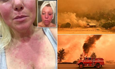 California Fires Cause Outbreak Of Allergic Rash Reactions In Residents