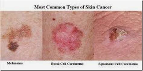 Skin Cancer Science Universe Physics Articles