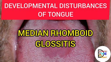 Median Rhomboid Glossitis Developmental Disturbances Of Tongue Youtube