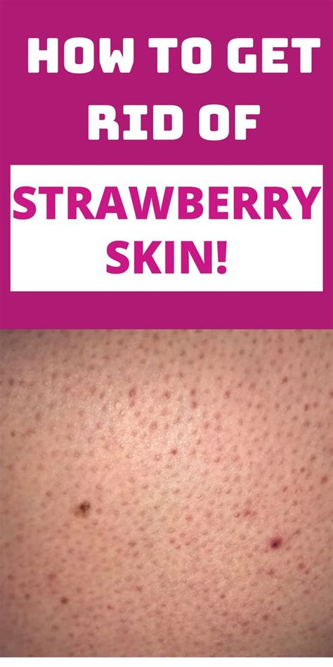 How To Get Rid Of Strawberry Legs Get Rid Of Keratosis Pilaris And Dark