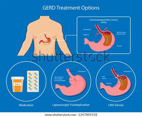 Gastroesophageal Reflux Disease Gerd Hiatal Hernia 스톡 벡터로열티 프리 1247809258