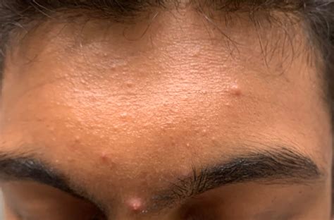 Skin Concern What Routinetreatment Would You Recommand To Improve