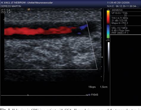 Figure 1 From Colour Duplex Ultrasonography Of The Temporal And