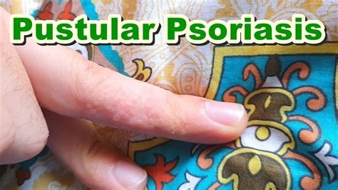 Pompholyx Of Pustular Psoriasis Topical Corticosteroids And Antibiotics