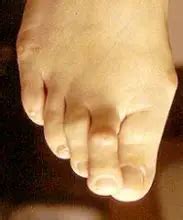 OVERLAPPING TOES Symptoms Diagnosis Treatment Prevention