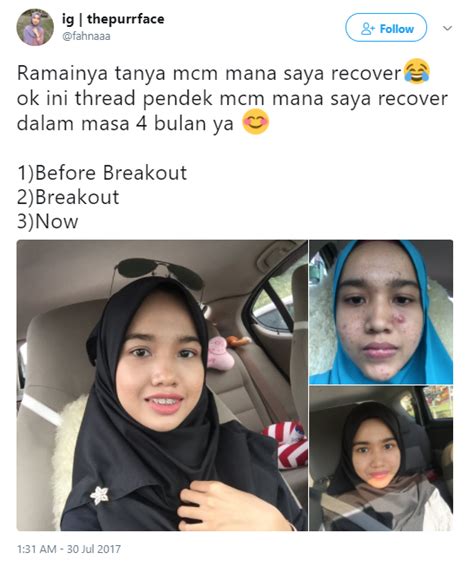 Maybe you would like to learn more about one of these? Muka Penuh Jerawat Termasuk Jerawat Batu, Amalan Digunakan ...