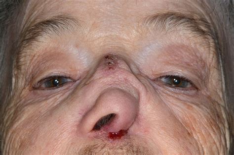 ‘saddle Nose Deformity Caused By Advanced Squamous Cell Carcinoma Of