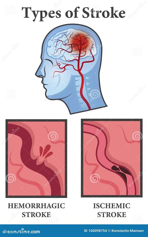 Vector Illustration Of Brain Stroke Types Ischemic And Hemorrhagic
