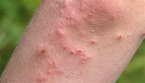What Does A Contact Dermatitis Rash Look Like